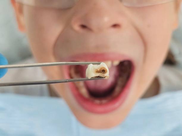 Best Emergency Treatment for Dental Infections or Abscesses in Rosepine, LA